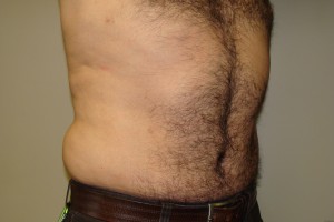 Tummy Tuck Before and After 63 | Grover Aesthetics