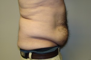 Tummy Tuck Before and After 63 | Grover Aesthetics