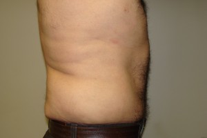 Tummy Tuck Before and After 63 | Grover Aesthetics
