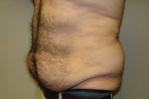 Tummy Tuck Before and After 63 | Grover Aesthetics