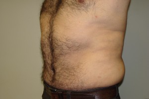 Tummy Tuck Before and After 63 | Sanjay Grover MD FACS