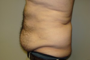 Tummy Tuck Before and After 63 | Grover Aesthetics