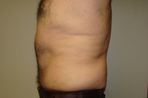 Tummy Tuck Before and After 63 | Grover Aesthetics