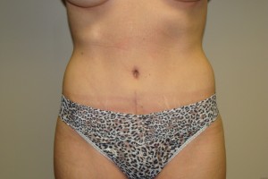 Tummy Tuck Before and After | Grover Aesthetics