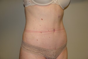 Tummy Tuck Before and After 64 | Sanjay Grover MD FACS
