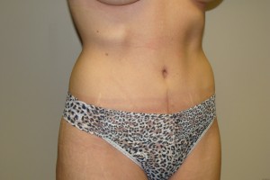 Tummy Tuck Before and After 64 | Sanjay Grover MD FACS