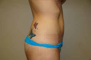 Tummy Tuck Before and After 64 | Sanjay Grover MD FACS