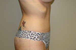 Tummy Tuck Before and After 64 | Grover Aesthetics