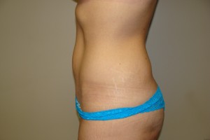 Tummy Tuck Before and After 64 | Sanjay Grover MD FACS