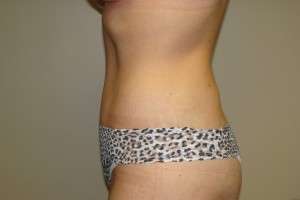 Tummy Tuck Before and After 64 | Grover Aesthetics