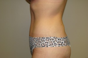 Tummy Tuck Before and After 64 | Sanjay Grover MD FACS