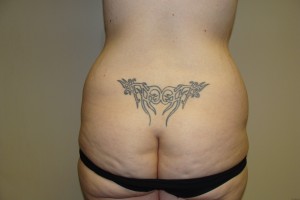 Tummy Tuck Before and After 64 | Grover Aesthetics