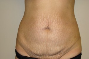 Tummy Tuck Before and After | Grover Aesthetics