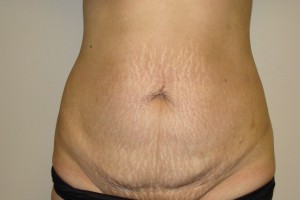 Tummy Tuck Before and After 46 | Sanjay Grover MD FACS