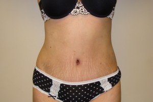 Tummy Tuck Before and After | Grover Aesthetics