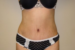 Tummy Tuck Before and After 65 | Sanjay Grover MD FACS