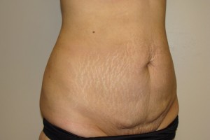Tummy Tuck Before and After 65 | Grover Aesthetics