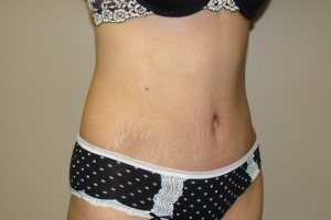 Tummy Tuck Before and After 65 | Grover Aesthetics