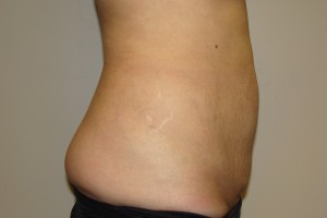 Tummy Tuck Before and After 65 | Grover Aesthetics