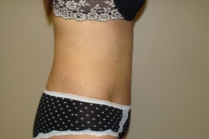 Tummy Tuck Before and After 65 | Grover Aesthetics