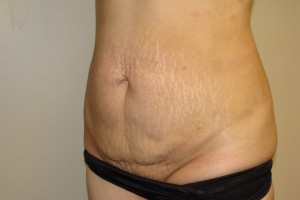 Tummy Tuck Before and After 65 | Grover Aesthetics