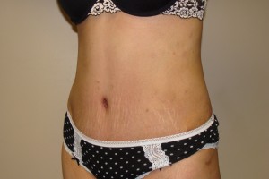 Tummy Tuck Before and After 65 | Grover Aesthetics