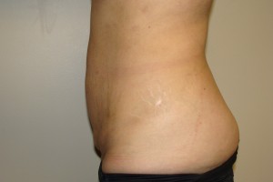 Tummy Tuck Before and After 65 | Grover Aesthetics