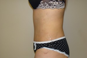 Tummy Tuck Before and After 65 | Grover Aesthetics