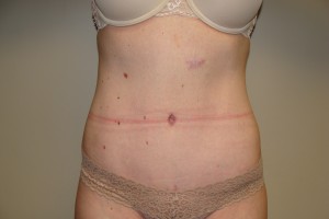 Tummy Tuck Before and After | Grover Aesthetics