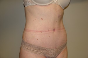 Tummy Tuck Before and After 66 | Grover Aesthetics