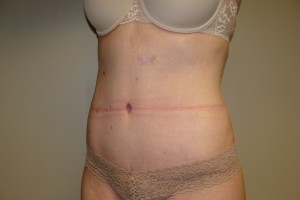 Tummy Tuck Before and After 66 | Grover Aesthetics