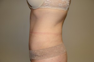 Tummy Tuck Before and After 66 | Grover Aesthetics