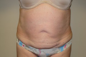 Tummy Tuck Before and After | Grover Aesthetics