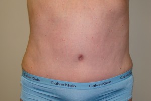 Tummy Tuck Before and After | Grover Aesthetics
