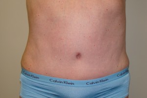 Tummy Tuck Before and After | Sanjay Grover MD FACS