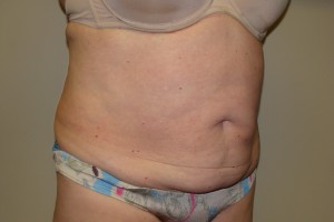 Tummy Tuck Before and After 67 | Grover Aesthetics