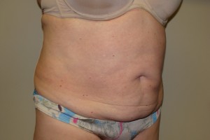 Tummy Tuck Before and After 67 | Sanjay Grover MD FACS