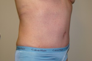 Tummy Tuck Before and After 67 | Grover Aesthetics