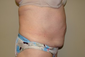 Tummy Tuck Before and After 67 | Sanjay Grover MD FACS