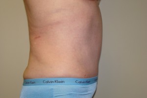 Tummy Tuck Before and After 67 | Grover Aesthetics