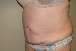 Tummy Tuck Before and After 67 | Sanjay Grover MD FACS