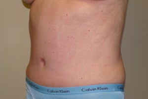 Tummy Tuck Before and After 67 | Grover Aesthetics