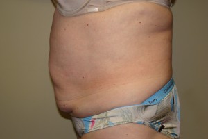 Tummy Tuck Before and After 67 | Sanjay Grover MD FACS