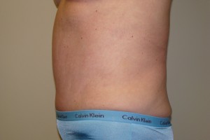 Tummy Tuck Before and After 67 | Grover Aesthetics