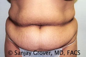 Tummy Tuck Before and After 60 | Sanjay Grover MD FACS