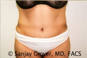 Tummy Tuck Before and After | Grover Aesthetics