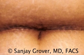 Tummy Tuck Before and After 68 | Grover Aesthetics