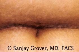 Tummy Tuck Before and After 68 | Sanjay Grover MD FACS