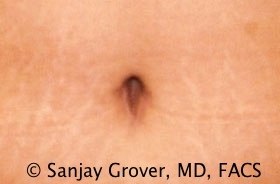 Tummy Tuck Before and After 68 | Grover Aesthetics