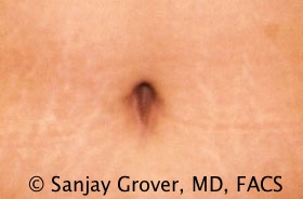 Tummy Tuck Before and After 68 | Sanjay Grover MD FACS